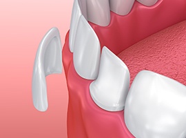 Animated dental veneer being placed on tooth by cosmetic dentist in Brick