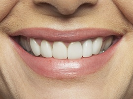 Closeup of smile with flawless teeth and gums
