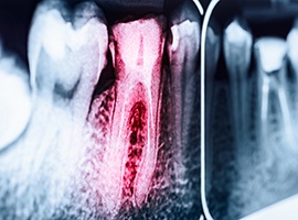Dental x ray with red highlighted tooth