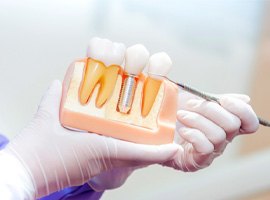 Close-up of dentist holding model of dental implant in Brick, NJ