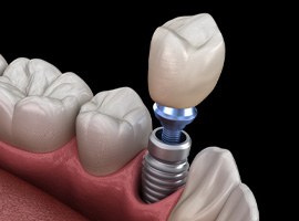 Render of a single dental implant in Brick, NJ in jaw