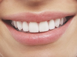 Closeup of flawless smile with veneers