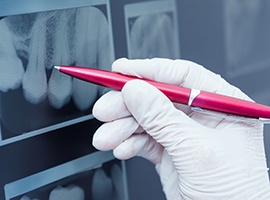 Pen pointing to digital dental x-ray